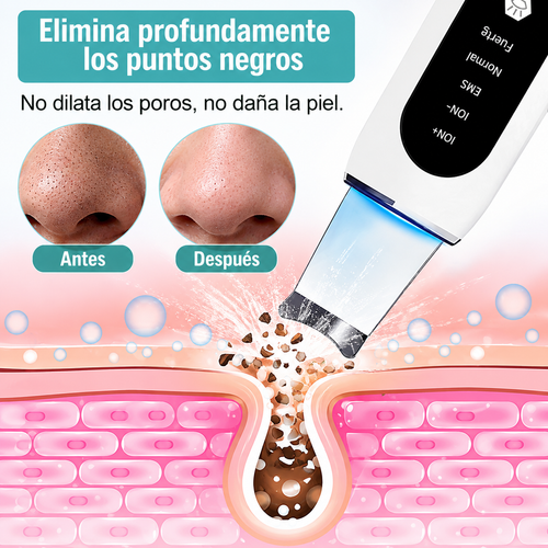 Espátula Facial Ultrasónica – Limpieza Profunda de Poros, Puntos Negros y Acné