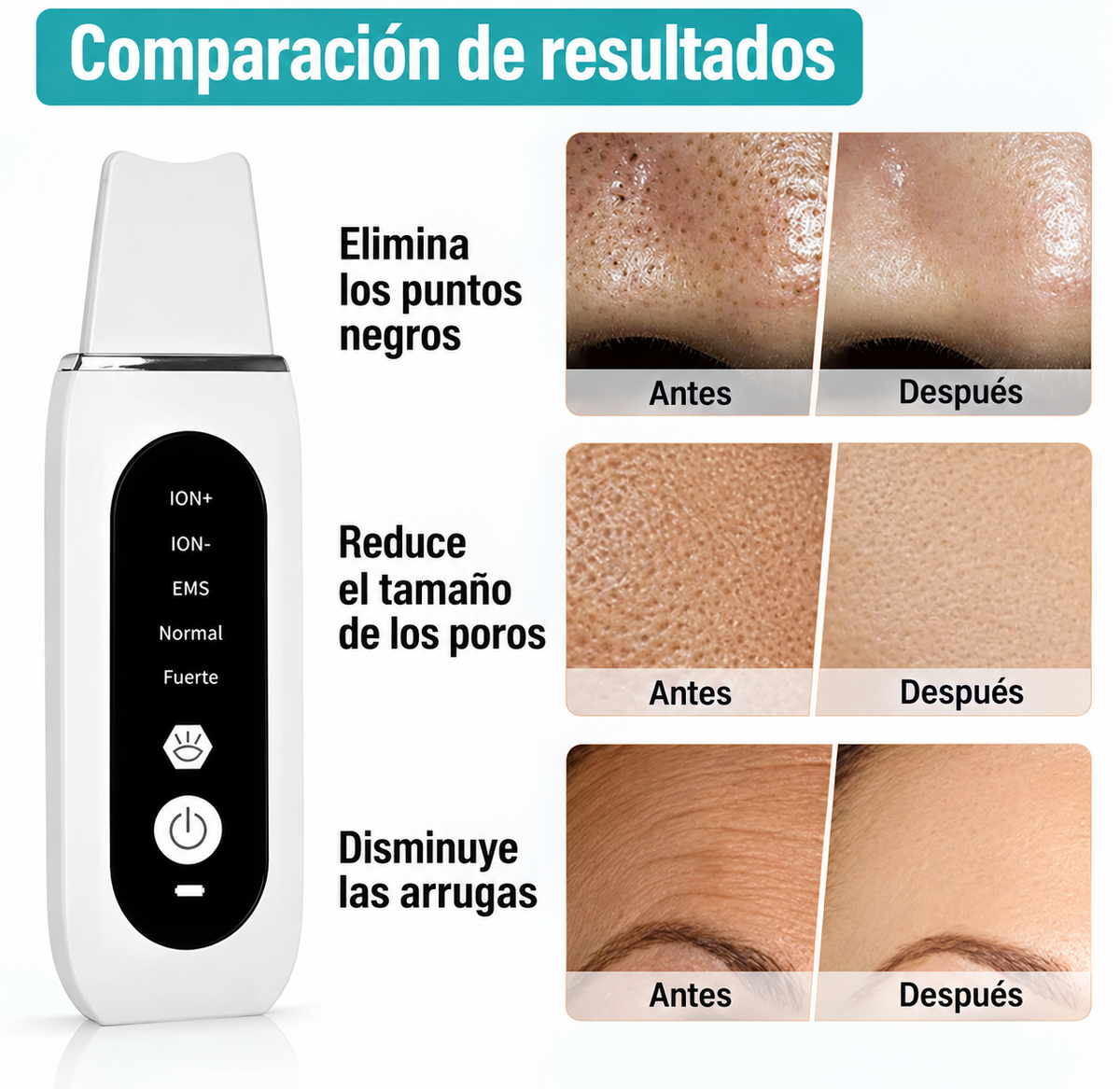 Espátula Facial Ultrasónica – Limpieza Profunda de Poros, Puntos Negros y Acné