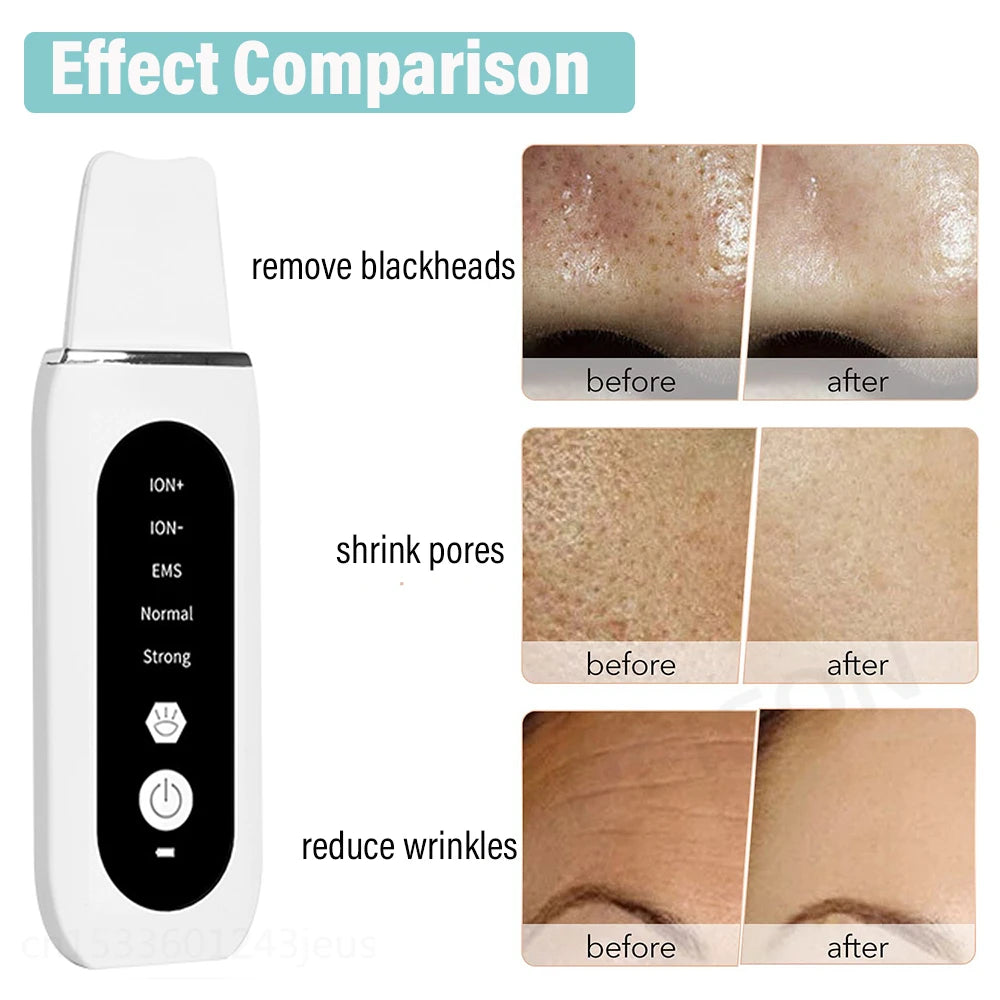 Espátula Facial Ultrasónica – Limpieza Profunda y Peeling