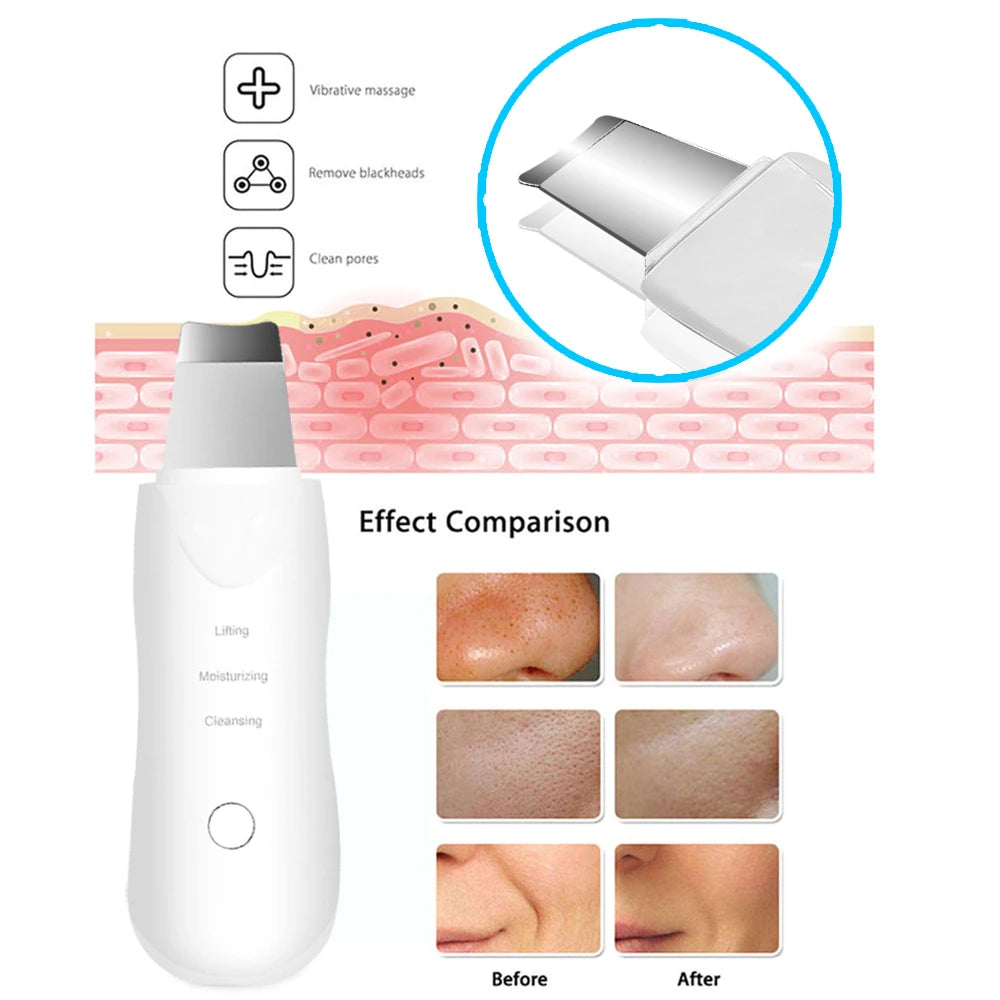 Espátula Facial Vibratoria – Limpieza de Poros y Lifting